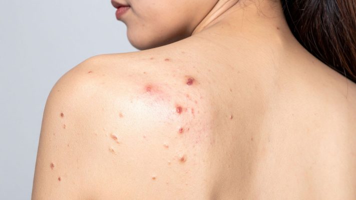 Sữa tắm cho người viêm da cơ địa